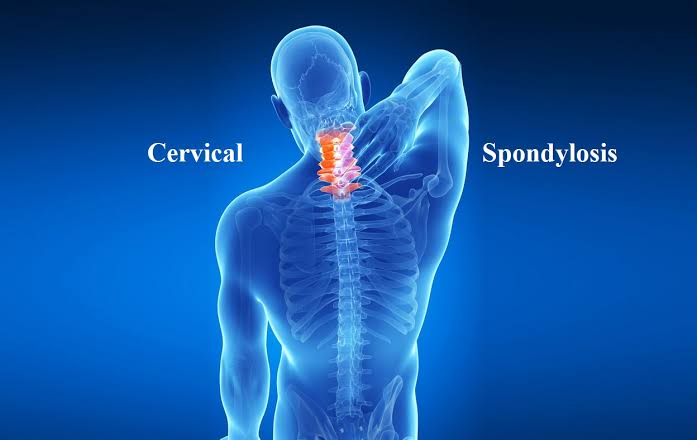 Cervical Spondylosis Ayurvedic Treatment: A Comprehensive Guide to Holistic Healing