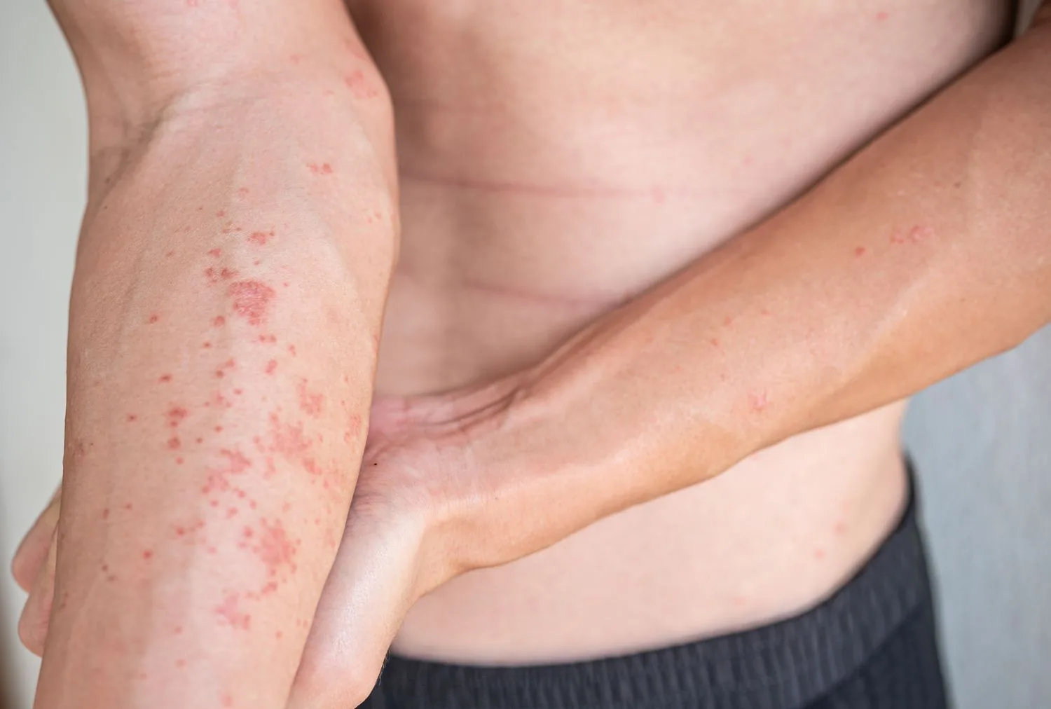 Ayurvedic Treatment for Atopic Dermatitis: A Comprehensive Guide for Skin Health