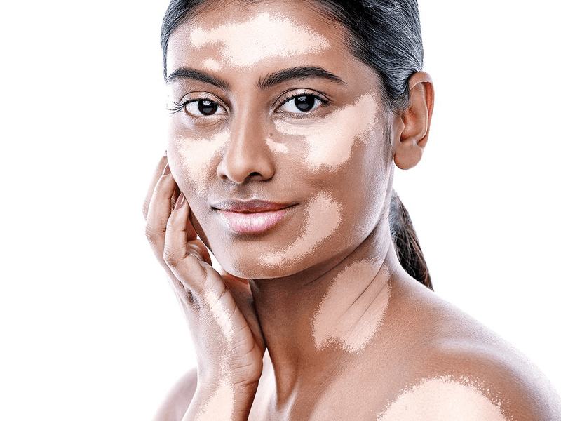 Vitiligo Treatment in Ayurveda: Unlocking the Secrets to Restoring Skin Pigmentation 
